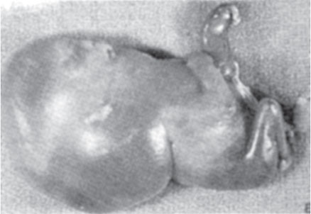 Feto de 12 semanas com higroma cístico e hidrópico (Isfer et al., 1996). 