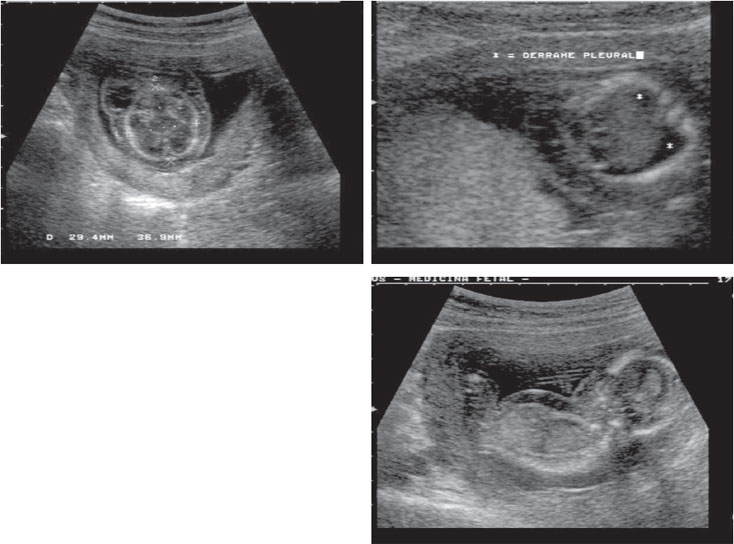 Ultra-sonografia de feto na 15ª semana de gestação com higroma cístico