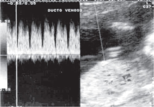 Forma De Onda Do Ducto Venoso Interpretação Do Doppler Obstétrico