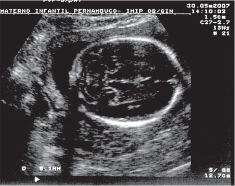 Avaliação do cerebelo, cisterna magna e prega nucal. 