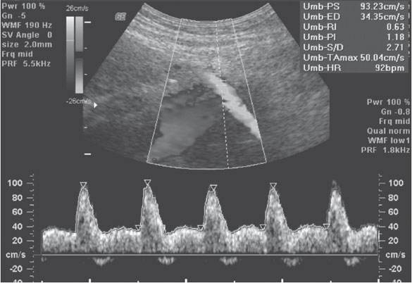 Artéria uterina anormal 