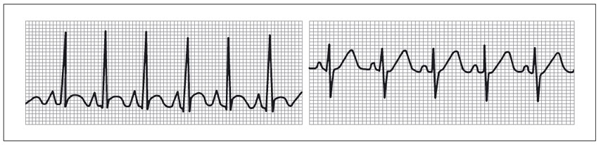 ECG mostrando taquicardia sinusal. 