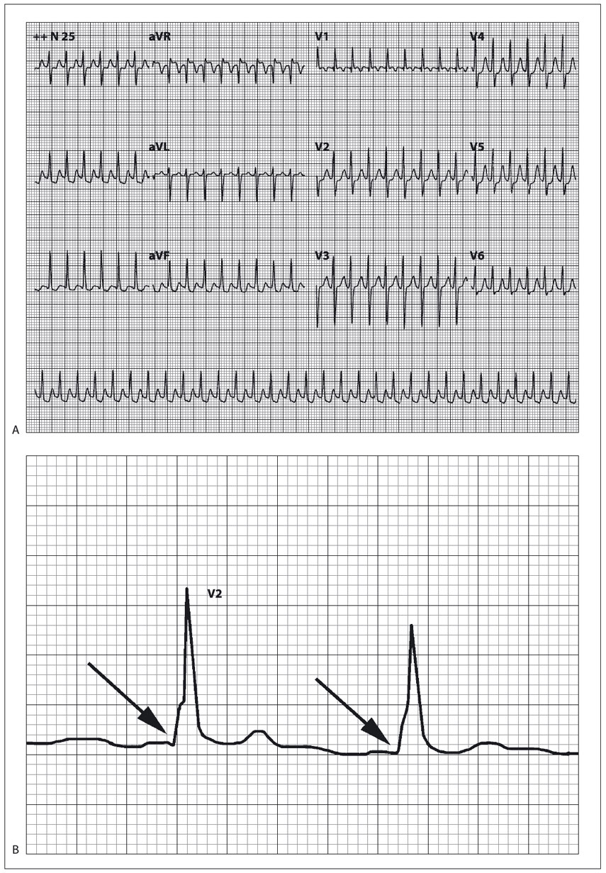 ECG mostrando taquicardia paroxística supraventricular