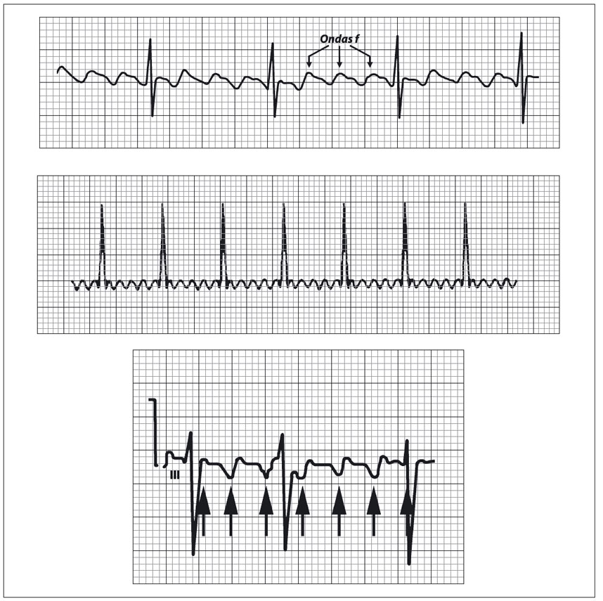 ECG mostrando flutter atrial com padrão serrilhado e ondas f características