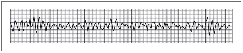 ECG mostrando FV com complexos totalmente anárquicos. 