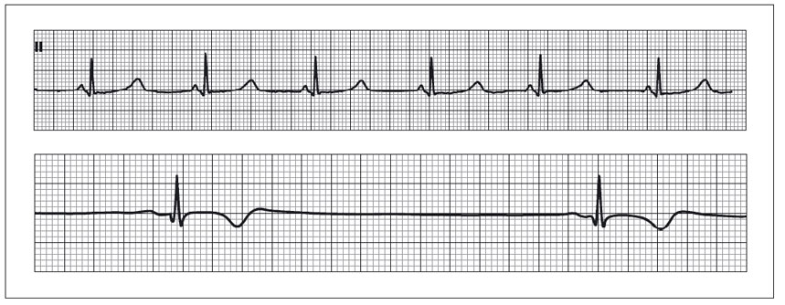 ECG mostrando FC muito baixa em bradicardia sinusal. 