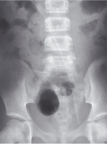 Radiografia de abdômen mostrando localização do cateter de Tenckhoff. 
