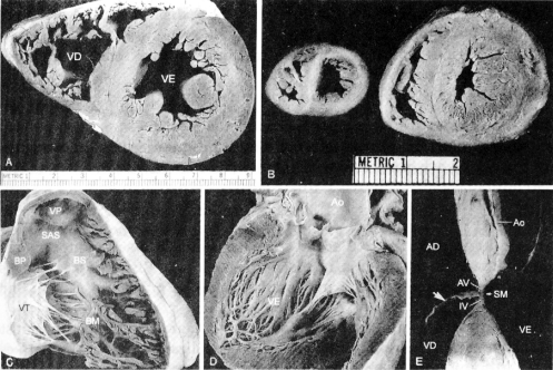 Corte transversal dos ventrículos, com evidente hipertrofia do